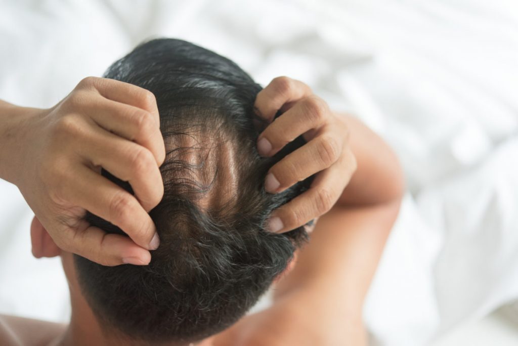 Natural Hair Loss Treatment